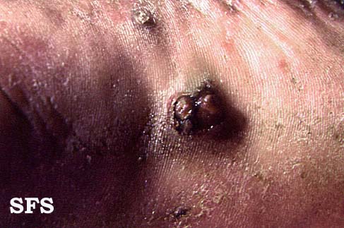 File:Angiosarcoma (Dermatology Atlas 2).jpg