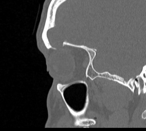 Angular epidermoid cyst (Radiopaedia 46908-51439 Sagittal bone window 75).png