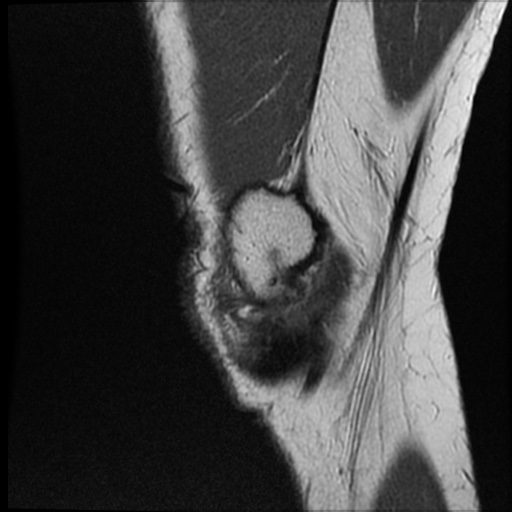 Anomalous insertion of the medial meniscus (Radiopaedia 77559-89721 Sagittal PD 46).jpg