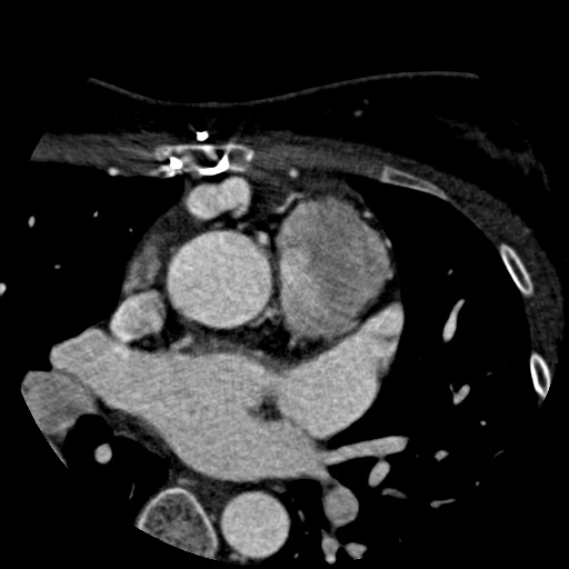 File:Anomalous left coronary artery from the pulmonary artery (ALCAPA) (Radiopaedia 40884-43586 A 12).jpg