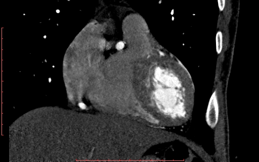 Anomalous left coronary artery from the pulmonary artery (ALCAPA) (Radiopaedia 70148-80181 B 91).jpg
