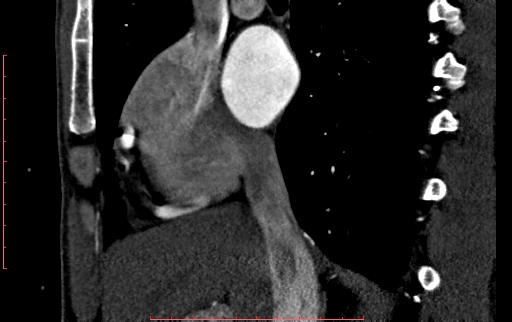 File:Anomalous left coronary artery from the pulmonary artery (ALCAPA) (Radiopaedia 70148-80181 C 48).jpg