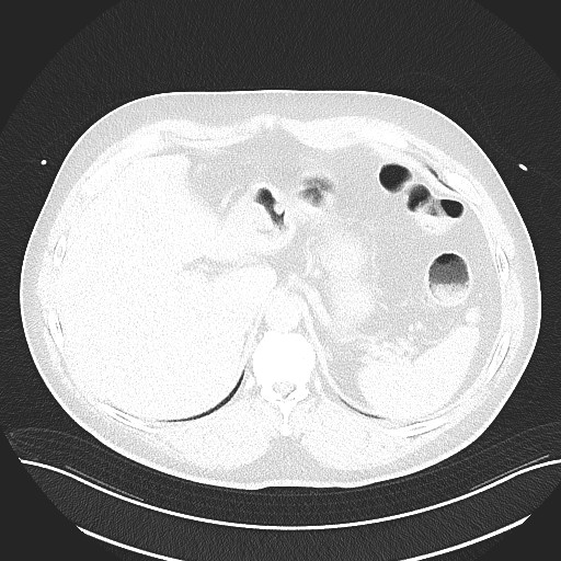 File:Anomalous origin of the left coronary artery with malignant course (Radiopaedia 77842-90126 Axial lung window 33).jpeg