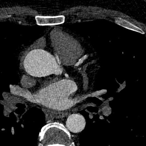 File:Anomalous origin of the left coronary artery with malignant course (Radiopaedia 77842-90126 C 29).jpeg