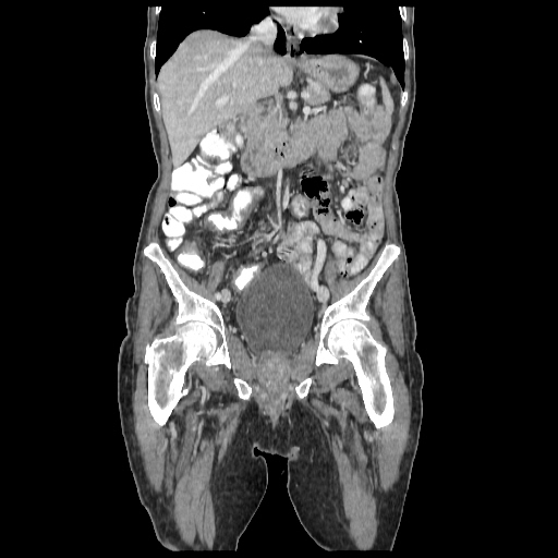 Anorectal carcinoma (Radiopaedia 44413-48064 B 36).jpg