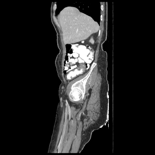Anorectal carcinoma (Radiopaedia 44413-48064 C 15).jpg