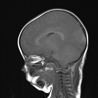 File:Anoxic brain injury (Radiopaedia 79165-92139 Sagittal T1 12).jpg
