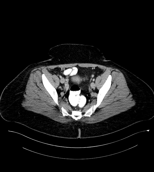 Anterior abdominal wall CSF pseudocyst (CSFoma) (Radiopaedia 79453-92571 A 77).jpg