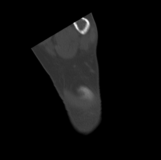 File:Anterior calcaneal process fracture (Radiopaedia 47384-51989 Coronal bone window 74).png