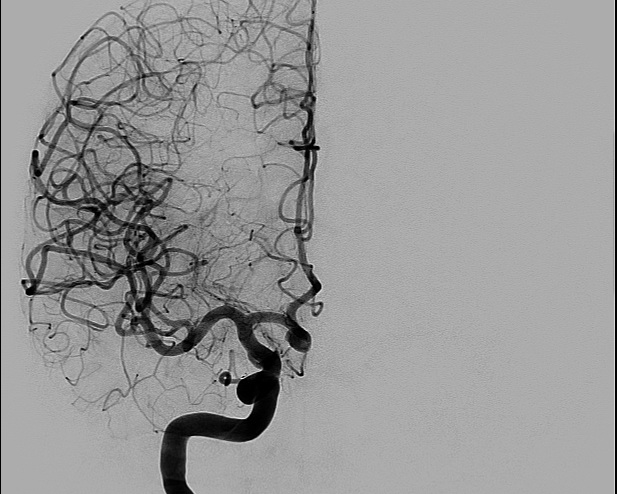 File:Anterior cerebral artery aneurysm (Radiopaedia 80683-94128 A 3).jpg