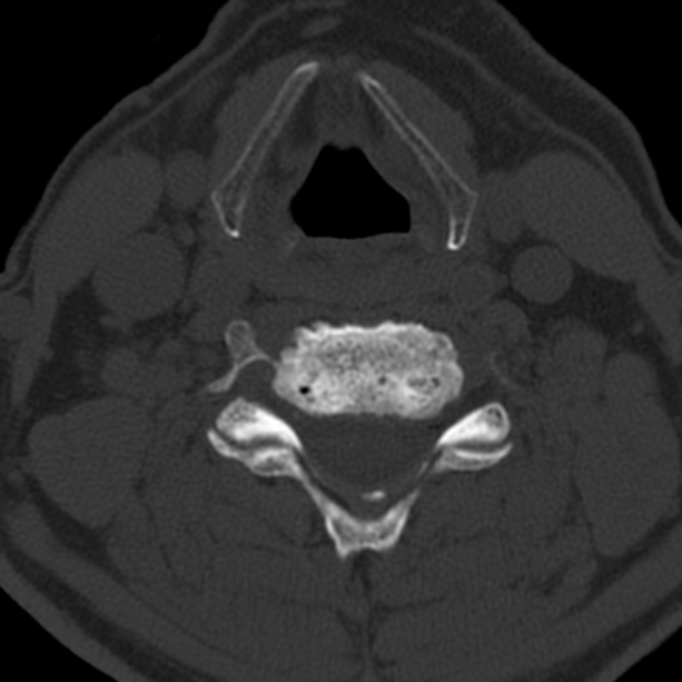 Anterior cervical postdiscectomy arthrodesis (Radiopaedia 32678-33646 Axial bone window 45).jpg