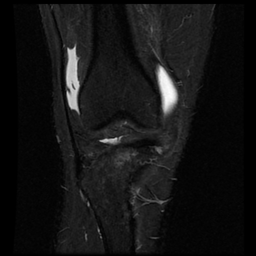 File:Anterior cruciate ligament avulsion fracture (Radiopaedia 58939-66193 Coronal STIR 6).jpg