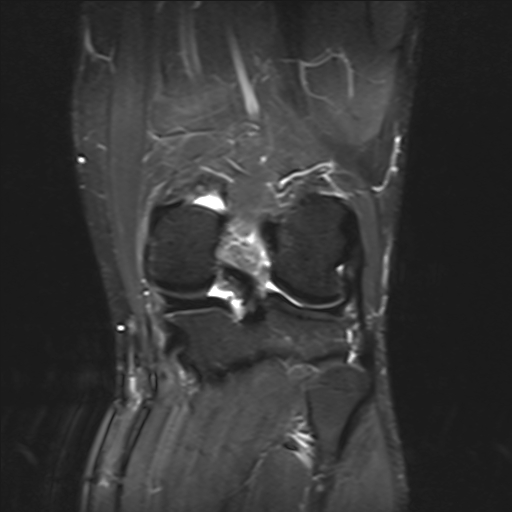 File:Anterior cruciate ligament full thickness tear (Radiopaedia 66268-75467 Coronal STIR 14).jpg