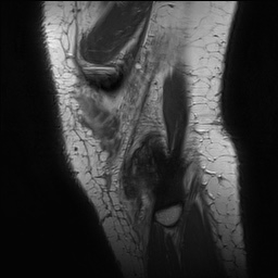 Anterior cruciate ligament rupture with Segond fracture (Radiopaedia 69043-78806 Sagittal PD 173).jpg