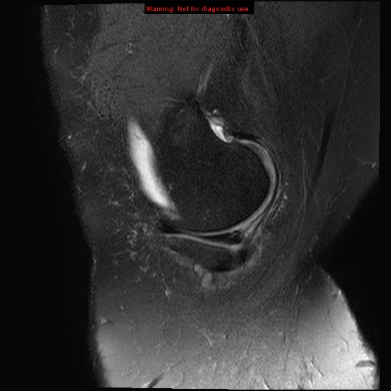 File:Anterior cruciate ligament tear - complete (Radiopaedia 12175-12514 Sagittal T2 fat sat 18).jpg