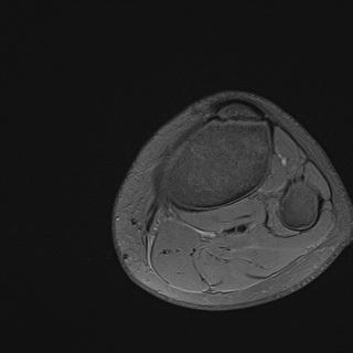 File:Anterior cruciate ligament tear - pediatric (Radiopaedia 62152-70260 Axial PD fat sat 37).jpg