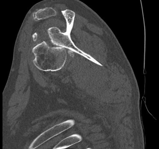 Anterior glenohumeral dislocation with Hill-Sachs lesion (Radiopaedia 62877-71249 Sagittal bone window 33).jpg