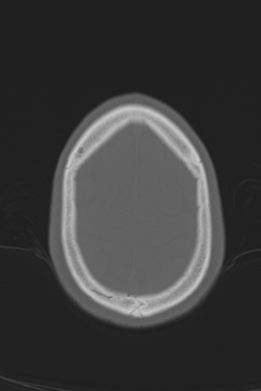 Anterior nasal spine fracture (Radiopaedia 46138-50494 Axial bone window 12).png