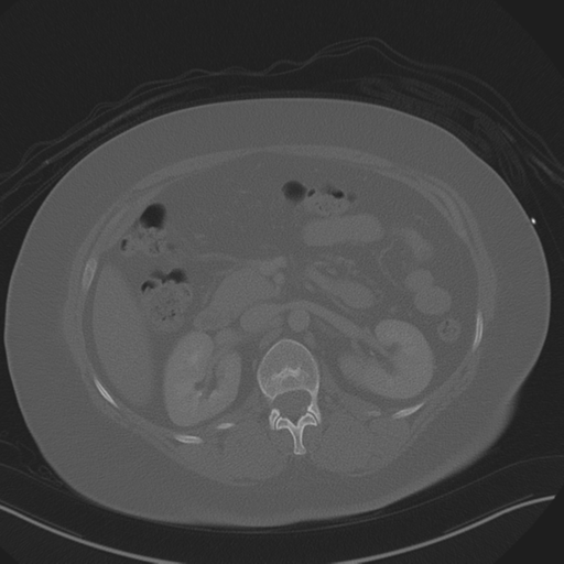 Anterior superior iliac spine avulsion fracture (Radiopaedia 44541-48244 Axial bone window 38).png