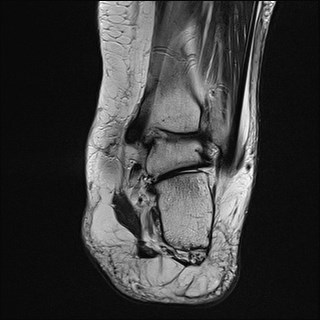 File:Anterior talofibular ligament injury - rupture with soft-tissue impingement (Radiopaedia 38765-40928 Coronal T2 12).jpg