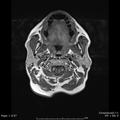 File:Anterior temporal lobe perivascular space (Radiopaedia 88283-104914 Axial T1 1).jpg