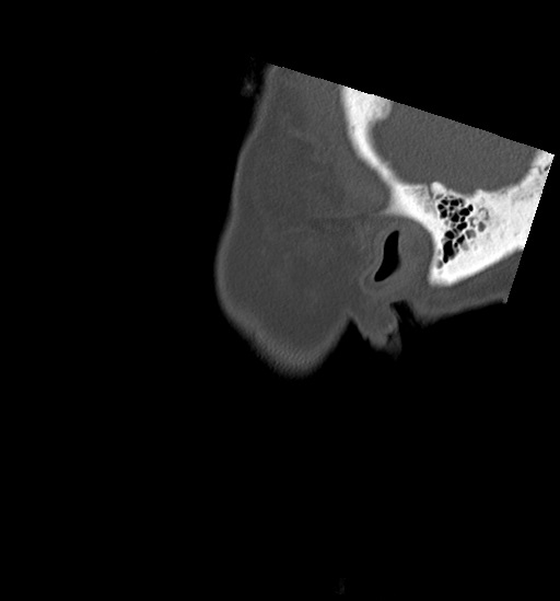 File:Anterior temporomandibular joint dislocation (Radiopaedia 59430-66784 B 63).jpg