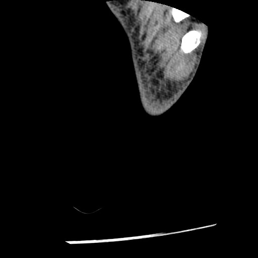 Anterior tibial artery false aneurysm (Radiopaedia 88984-105809 A 268).jpg