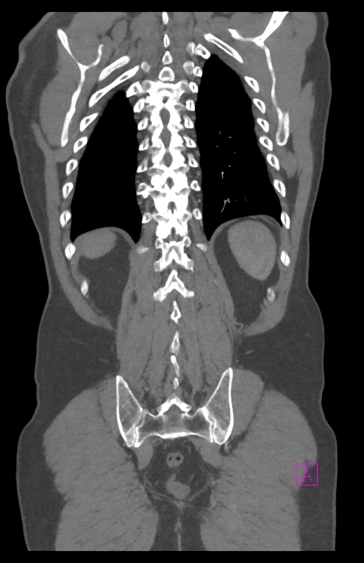 Aortectomy and axillary-bifemoral bypass (Radiopaedia 28303-28545 C 75).jpg