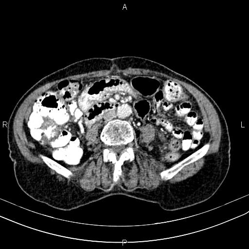 File:Aortic aneurysm and Lemmel syndrome (Radiopaedia 86499-102554 A 46).jpg
