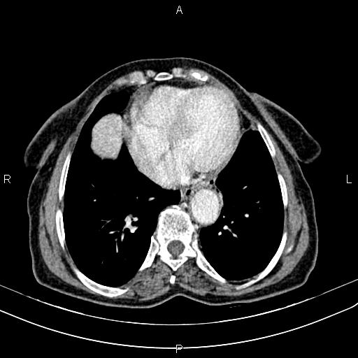 File:Aortic aneurysm and Lemmel syndrome (Radiopaedia 86499-102554 A 6).jpg
