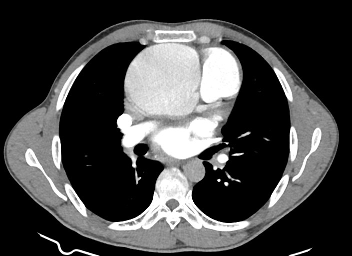 File:Aortic coarctation with aneurysm (Radiopaedia 74818-85828 A 115).jpg