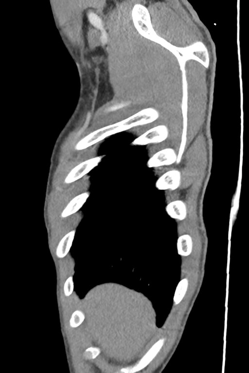 Aortic coarctation with aneurysm (Radiopaedia 74818-85828 B 22).jpg