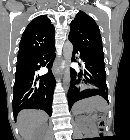 Aortic coarctation with aneurysm (Radiopaedia 74818-85828 C 80).jpg