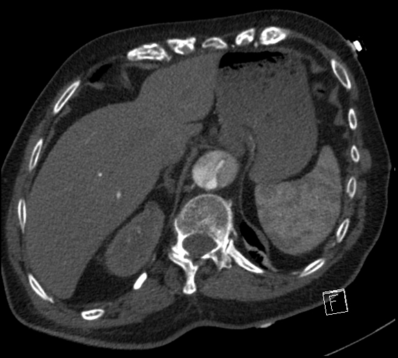 Aortic dissection (CTPA) (Radiopaedia 75506-86750 A 83).jpg