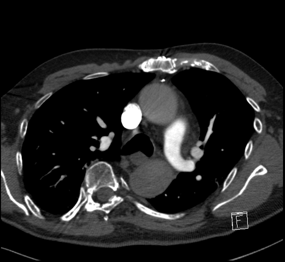 File:Aortic dissection (CTPA) (Radiopaedia 75506-86751 Axial C+ CTPA 55).jpg