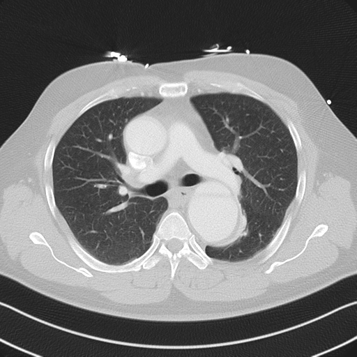 File:Aortic dissection (Radiopaedia 50763-56234 Axial lung window 30).png