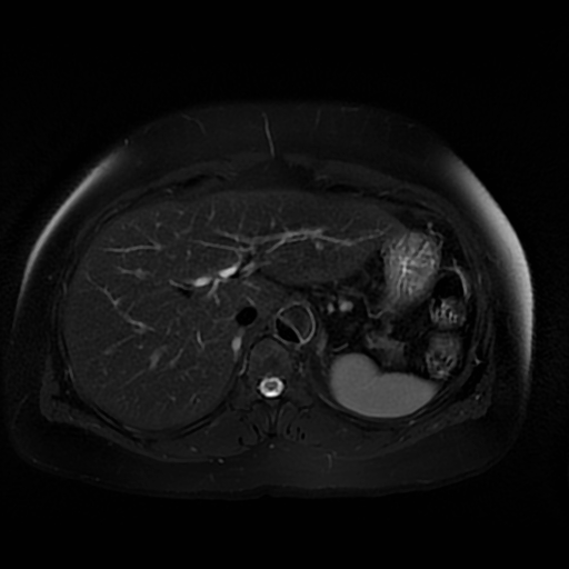 File:Aortic dissection (Radiopaedia 57969-64956 Axial T2 fat sat 20).jpg