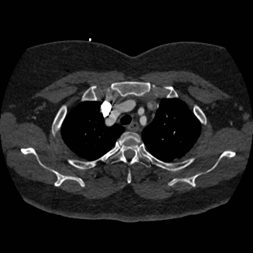 Aortic dissection (Radiopaedia 57969-64959 A 67).jpg