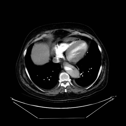 Aortic dissection (Radiopaedia 62562-71000 A 34).jpg