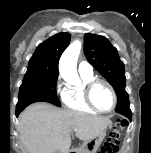Aortic dissection - Stanford type B (Radiopaedia 50171-55512 B 24).png
