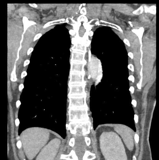 File:Aortic dissection - Stanford type B (Radiopaedia 50171-55512 B 66).png