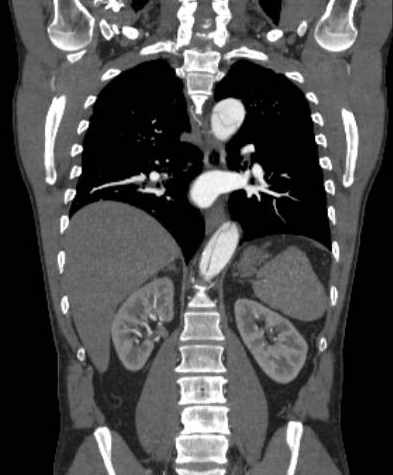 File:Aortic dissection - Stanford type B (Radiopaedia 73648-84437 B 77).jpg
