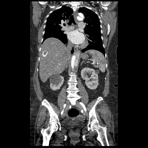 File:Aortic dissection - Stanford type B (Radiopaedia 88281-104910 B 44).jpg