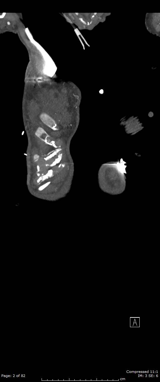 Aortic dissection with extension into aortic arch branches (Radiopaedia 64402-73204 A 2).jpg