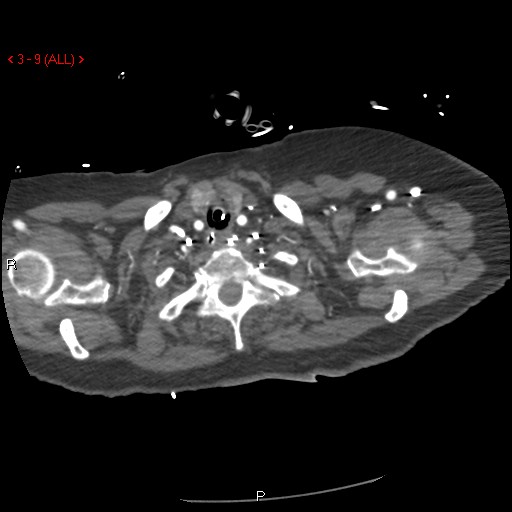 Aortic intramural hematoma (Radiopaedia 27746-28001 A 9).jpg