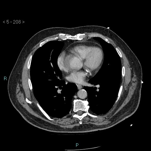 Aortic intramural hematoma (Radiopaedia 48463-53380 C 94).jpg