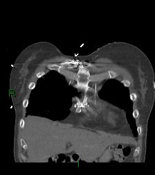 Aortic valve endocarditis (Radiopaedia 87209-103485 D 60).jpg