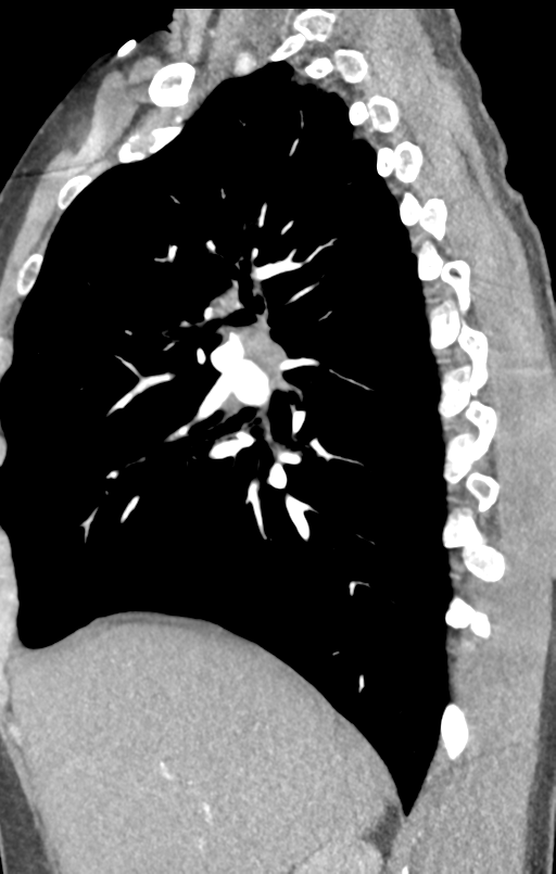 Aortic valve non-coronary cusp thrombus (Radiopaedia 55661-62189 C+ arterial phase 44).png