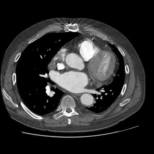 File:Aorto-coronary bypass graft aneurysms (Radiopaedia 40562-43157 A 67).png