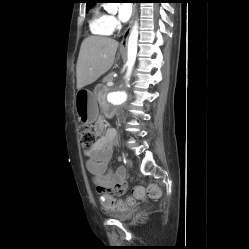 File:Aorto-duodenal fistula (Radiopaedia 25668-25850 C+ arterial phase 10).jpg